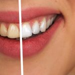 Co warto wiedzieć na temat skutecznego wybielania zębów?